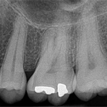 digital x rays